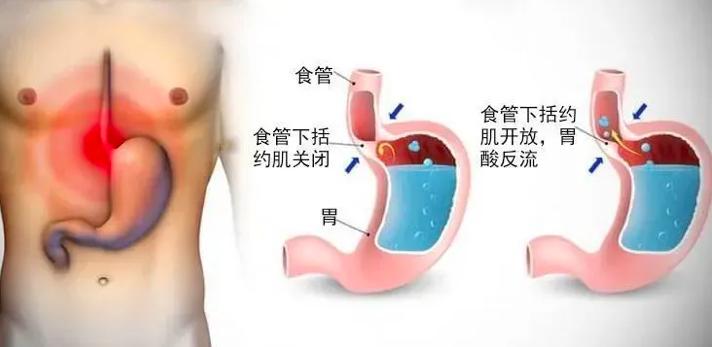 孕8个月反酸，孕期常见症状的应对与解析