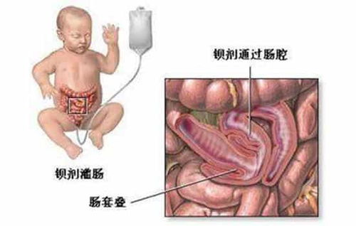 九个月宝宝肠梗阻，家长如何应对与预防