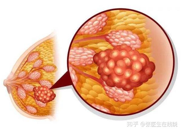 乳腺结节一个月内增大的原因与应对策略